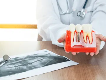Modelo de implante dental