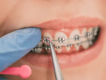 Ajuste de brackets de ortodoncia