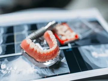 Prótesis dental sobre una radiografía